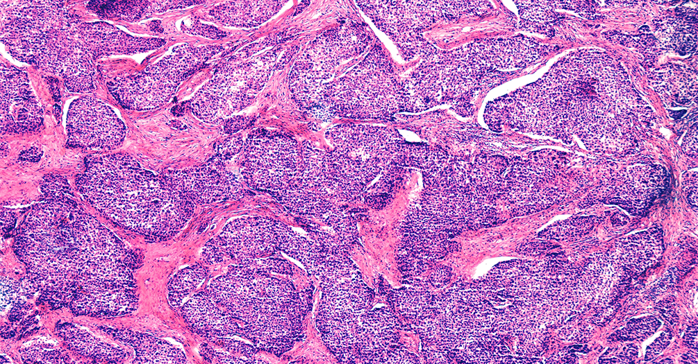 human ovary carcinoma under microscope